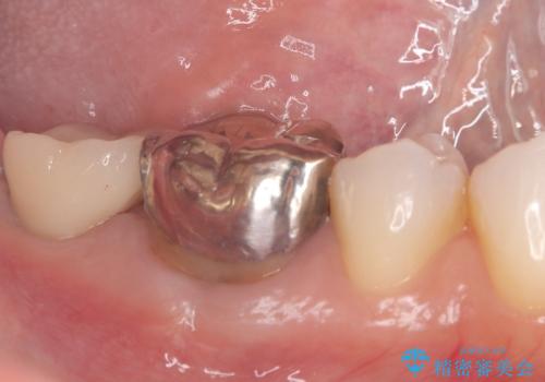 歯のインプラント治療|1回の手術で負担を軽減し、自然な噛み心地を再現の治療後