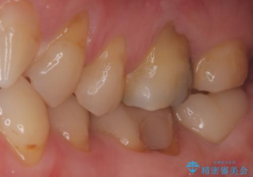 他院の根管治療後の違和感を解消!精密な根管治療で健康な歯を守るの治療後