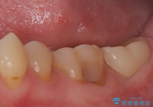 他院の根管治療後の違和感を解消!精密な根管治療で健康な歯を守るの治療後
