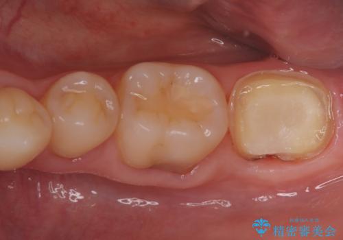 他院の根管治療後の違和感を解消!精密な根管治療で健康な歯を守るの治療中