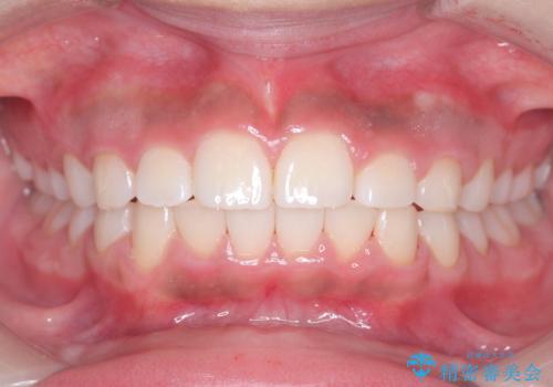 前歯の突出を抜歯なしで改善|リンガルアーチ×TADを活用した矯正治療の治療後