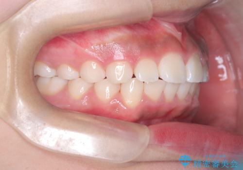 前歯の突出を抜歯なしで改善|リンガルアーチ×TADを活用した矯正治療の治療後