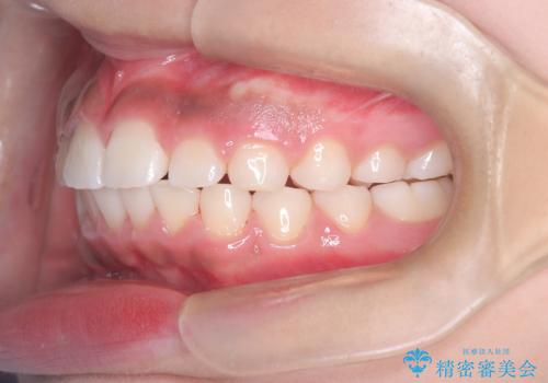 前歯の突出を抜歯なしで改善|リンガルアーチ×TADを活用した矯正治療の治療後