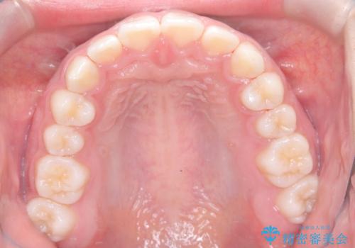 前歯の突出を抜歯なしで改善|リンガルアーチ×TADを活用した矯正治療の治療後