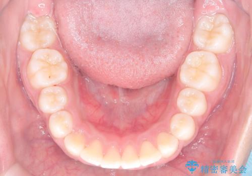 前歯の突出を抜歯なしで改善|リンガルアーチ×TADを活用した矯正治療の治療後