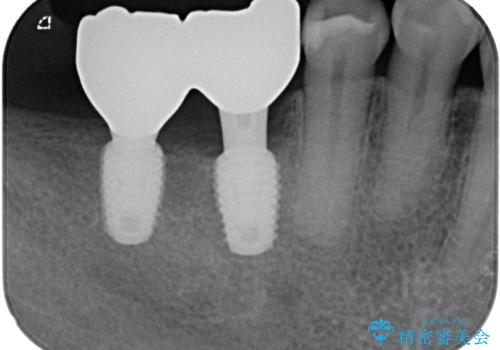 抜歯したところにインプラント治療をしたい。の治療後
