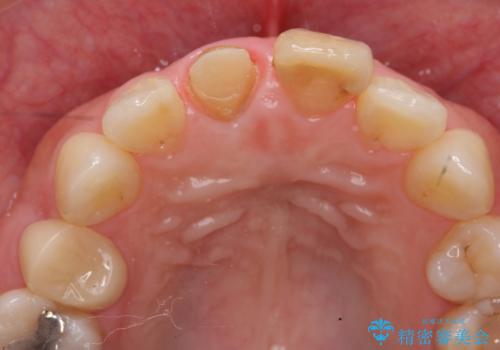 [ セラミック治療 ]  前歯の変色をきれいにしたいの治療中