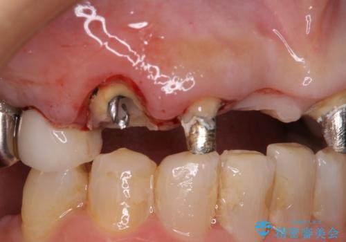 割れてしまった歯と深いむし歯 部分矯正と外科処置で安定したブリッジ治療の治療前