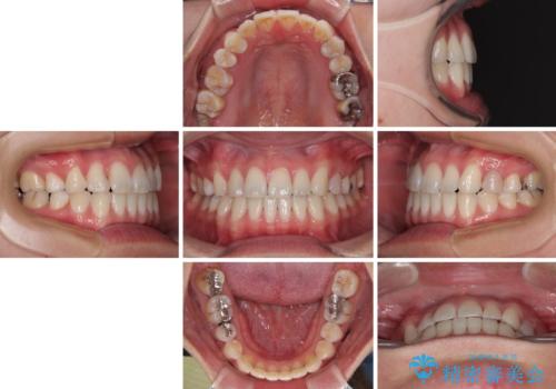 マウスピース矯正が煩わしい　ワイヤー装置での非抜歯矯正の治療後