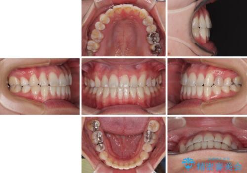 マウスピース矯正が煩わしい ワイヤー装置での非抜歯矯正の治療後