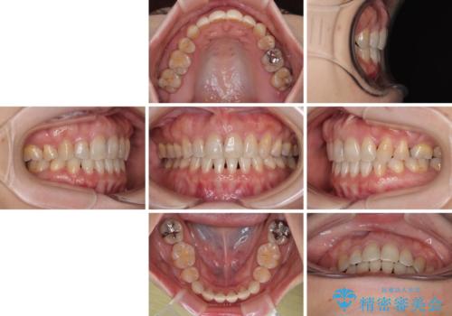 抜歯矯正 ワイヤー装置で横顔の印象を改善の治療後
