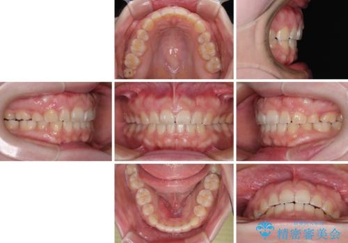 口元の突出感を治したい ワイヤー装置を用いた抜歯矯正の治療後