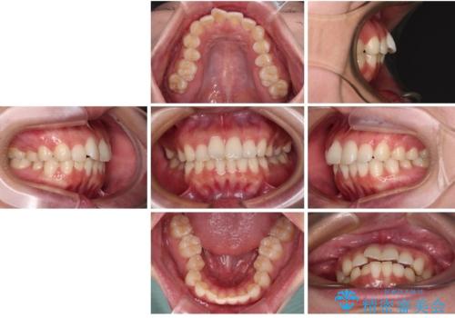 口元の突出感を改善したい。審美装置による抜歯矯正の治療前