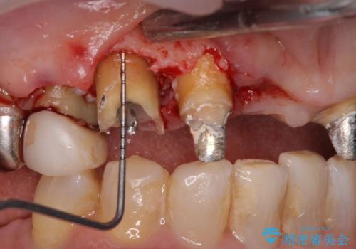 割れてしまった歯と深いむし歯 部分矯正と外科処置で安定したブリッジ治療の治療中