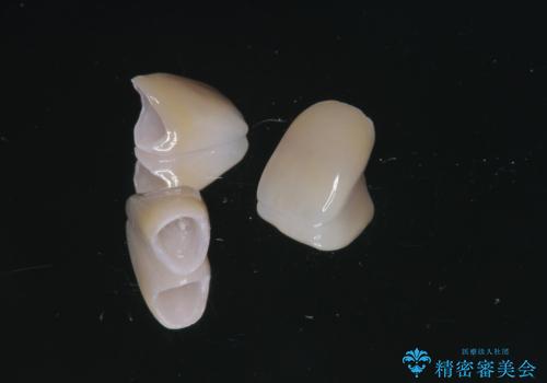 前歯のフチが黒いのが気になる 前歯のセラミック治療