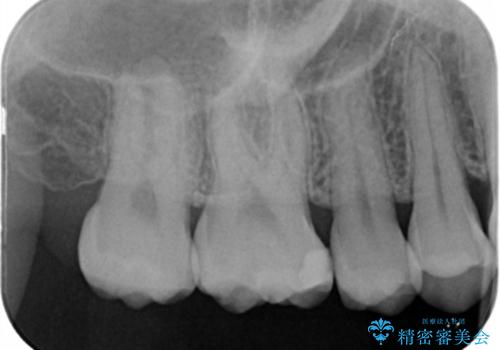 奥歯の保険の詰め物を自費のものに変えたいの治療前