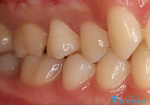 奥歯の保険の詰め物を自費のものに変えたいの治療中