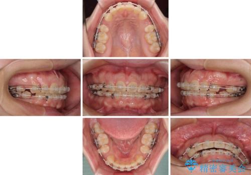 口元の突出感を治したい ワイヤー装置を用いた抜歯矯正の治療中