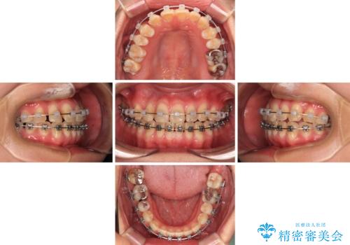 マウスピース矯正が煩わしい　ワイヤー装置での非抜歯矯正の治療中