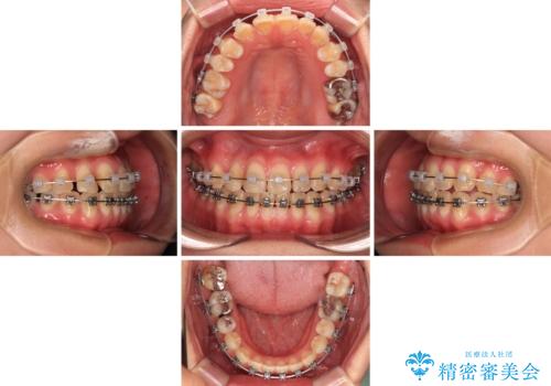 マウスピース矯正が煩わしい ワイヤー装置での非抜歯矯正の治療中