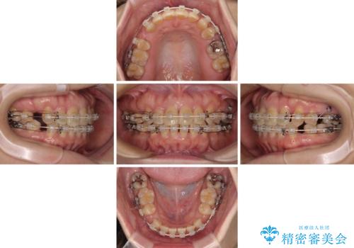 抜歯矯正 ワイヤー装置で横顔の印象を改善の治療中