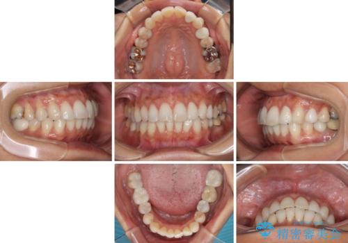 むし歯と前歯のデコボコを治したい　インビザラインを使用した総合歯科治療の治療中