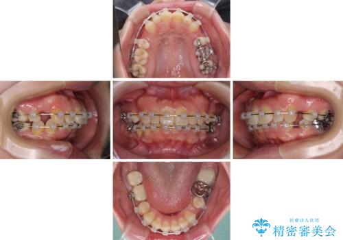 気になる出っ歯を治したい　ワイヤー装置の抜歯矯正でスッキリした横顔にの治療中