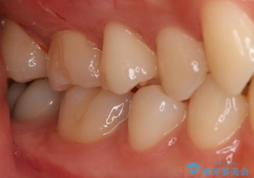奥歯の保険の詰め物を自費のものに変えたいの治療後
