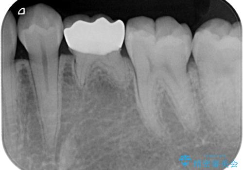 乳歯に虫歯ができた オールセラミッククラウンの治療後