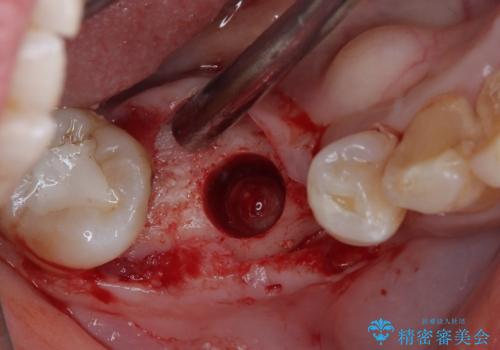 割れてしまった奥歯 インプラントによる補綴治療の治療中