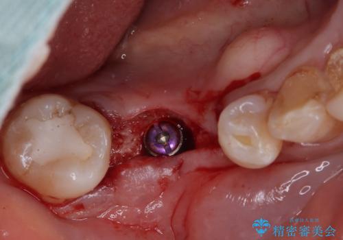 割れてしまった奥歯 インプラントによる補綴治療の治療前