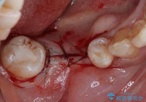 割れてしまった奥歯 インプラントによる補綴治療の治療中