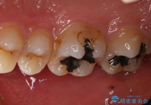 銀歯を白くしたい フルジルコニアクラウンとセラミックインレーの治療前