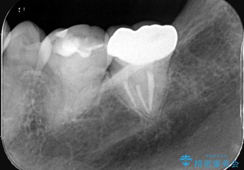 他院の根管治療後の違和感を解消!精密な根管治療で健康な歯を守るの治療後