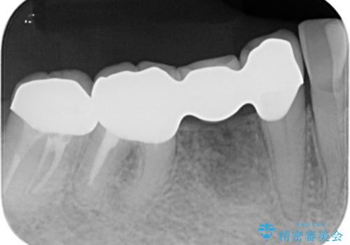 70代女性 状態の悪い歯を抜歯して、奥歯をブリッジにの治療後