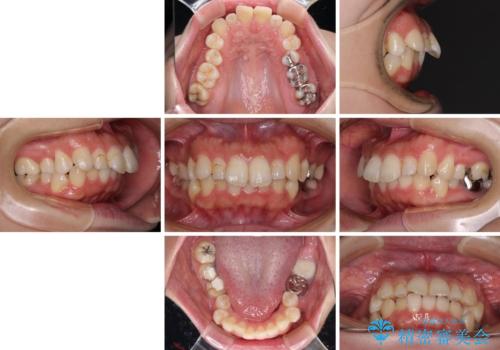 気になる出っ歯を治したい　ワイヤー装置の抜歯矯正でスッキリした横顔にの治療前