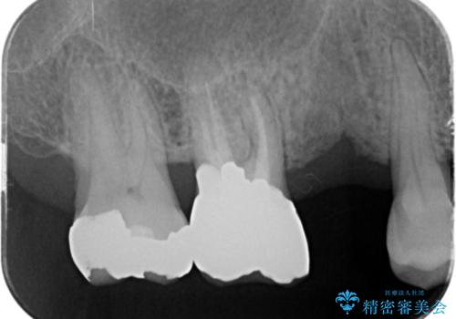 失った奥歯のインプラント治療の治療前