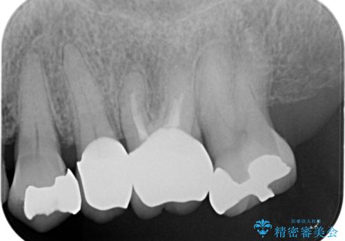 70代女性　段差のある被せ物のやり替え　の治療後