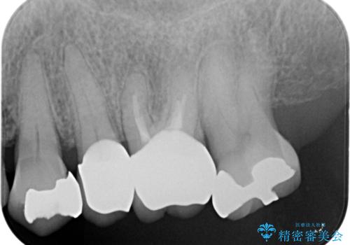 70代女性 段差のある被せ物のやり替え の治療後
