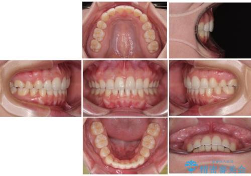 口元の突出感を改善したい。審美装置による抜歯矯正の治療後