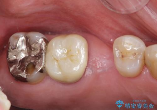 失った奥歯のインプラント治療の治療前