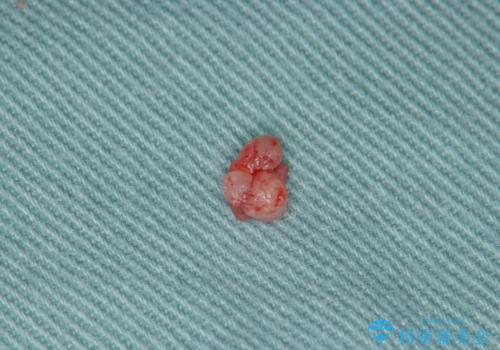 粘液嚢胞の切除の治療前