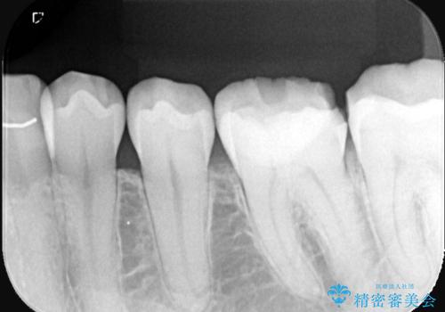 【セラミッククラウン】歯がポロポロ欠けたの治療前
