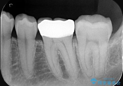 【セラミッククラウン】歯がポロポロ欠けたの治療後