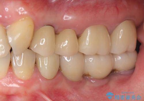 破折歯のインプラント治療、奥歯の根管・セラミック治療の症例 治療後