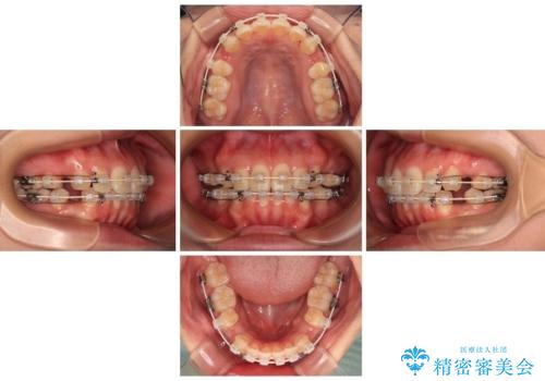 口元の突出感を改善したい。審美装置による抜歯矯正の治療中