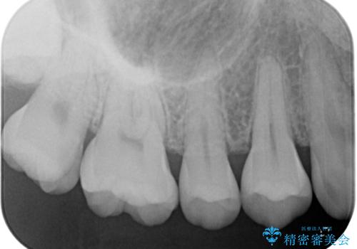 はじめて虫歯ができた ゴールドインレー修復の治療前