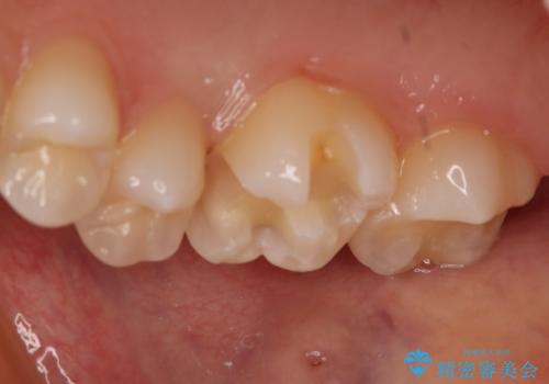 奥歯の保険の詰め物を自費のものに変えたいの治療中