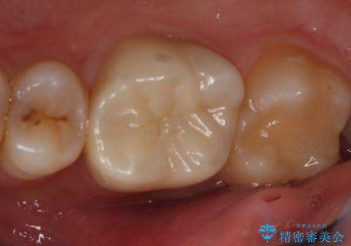 銀歯を白くしたい フルジルコニアクラウンとセラミックインレー