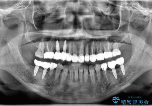虫歯・噛み合わせ・インプラント、全顎総合治療の治療後